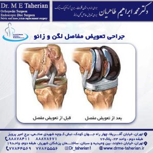 جراحی تعویض مفاصل لگن و زانو - دکتر محمد ابراهیم طاهریان