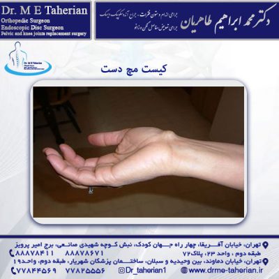 کیست مچ دست