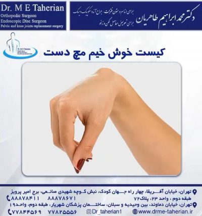 کیست مچ دست