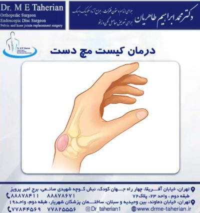 کیست مچ دست