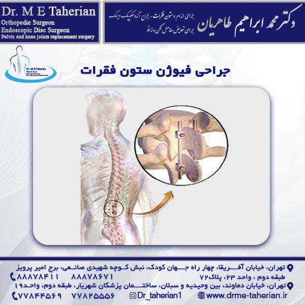 جراحی فیوژن ستون فقرات