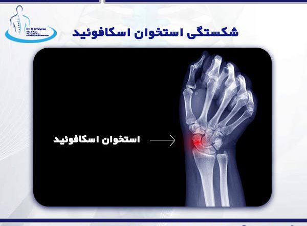 شکستگی استخوان اسکافوئید + دکتر طاهریان