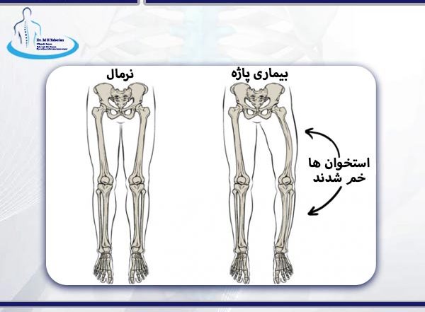 بیماری پاژه استخوان + دکتر ابراهیم طاهریان