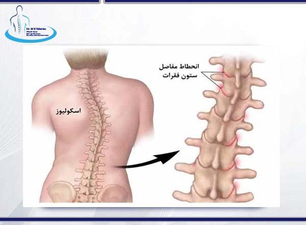 اسکولیوز