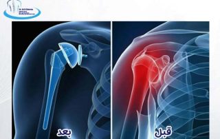دلایل و نحوه چگونگی عمل تعویض مفصل شانه