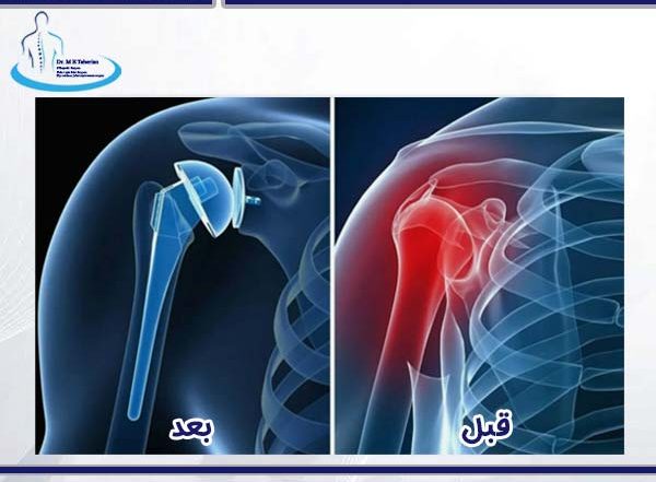 دلایل و نحوه چگونگی عمل تعویض مفصل شانه