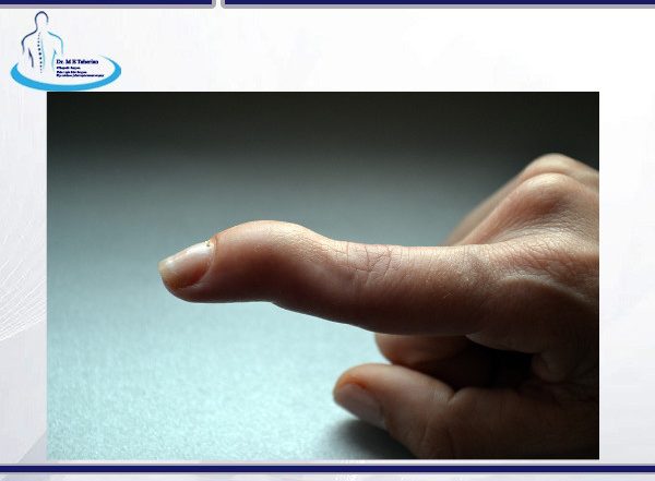 انگشت چکشی - دکتر محمد ابراهمی طاهریان https://drme-taherian.ir/