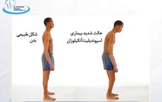 اسپوندیلیت آنکیلوزان