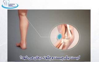 کیست بیکر چیست و چگونه درمان می شود؟