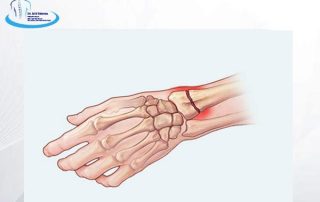 شکستگی مچ دست