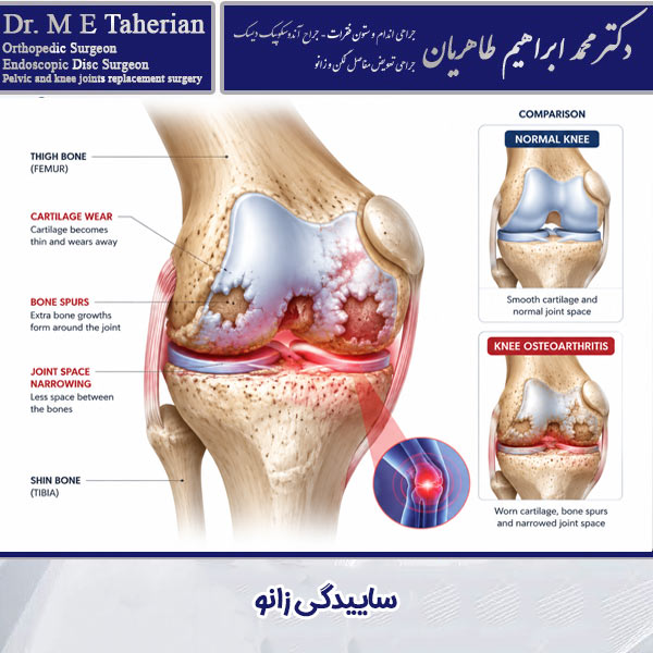 ساییدگی زانو - دکتر طاهریان