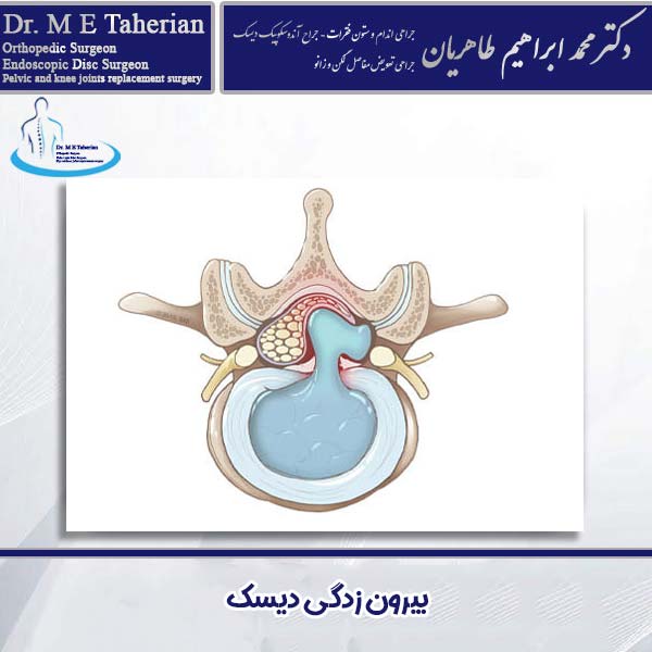 بیرون زدگی دیسک